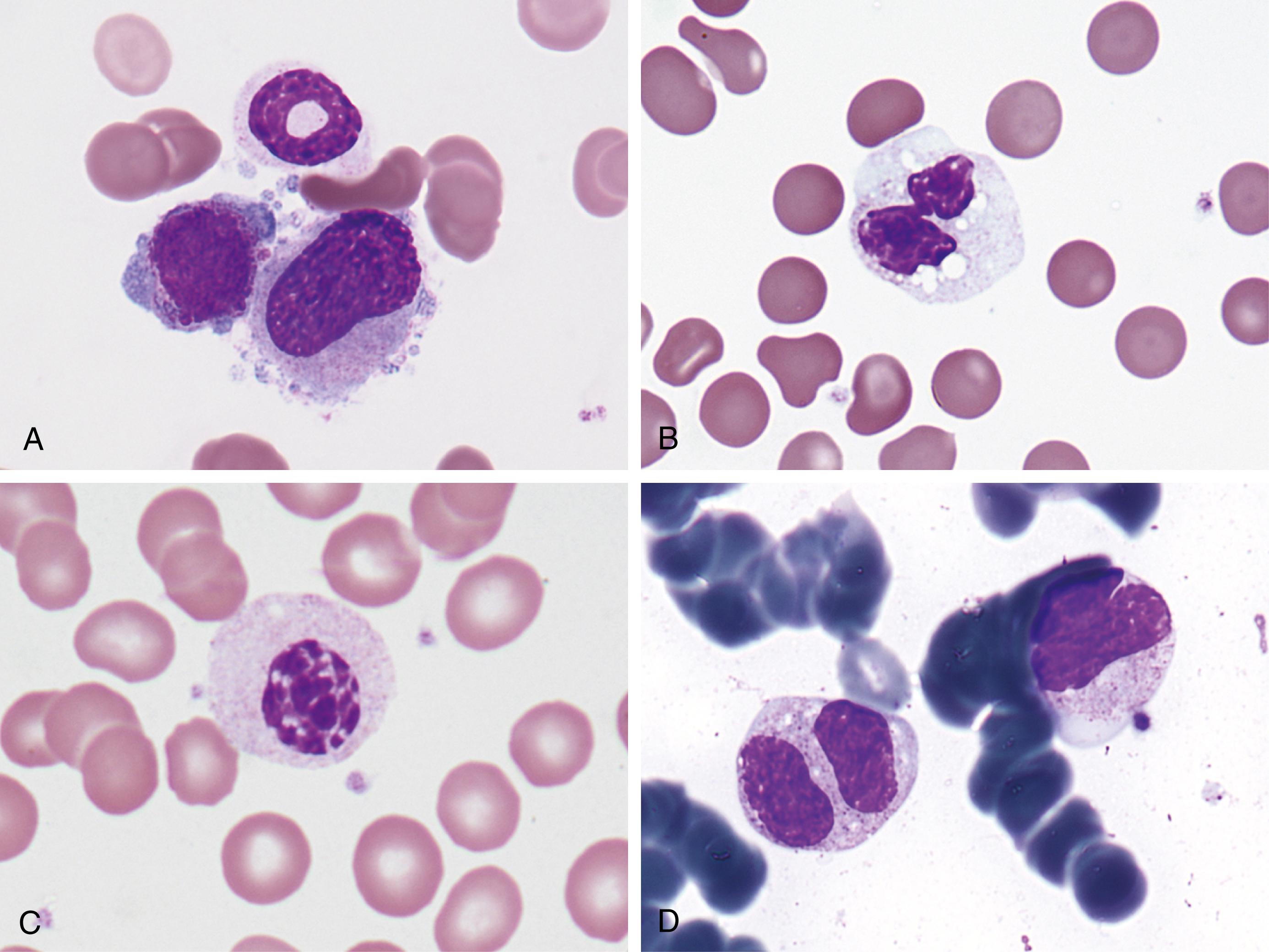 Figure 34.21, Other forms of neutrophil dysplasia. A, Ring neutrophil along with dysplastic erythroid and megakaryocytic cells in the marrow (×1000). B, Pelger-Huët neutrophil resembling a monocyte (×1000). C, Mononuclear Pelger-Huët cell (×1000). D, Large, irregularly lobulated and granulated neutrophil precursors (×1000).