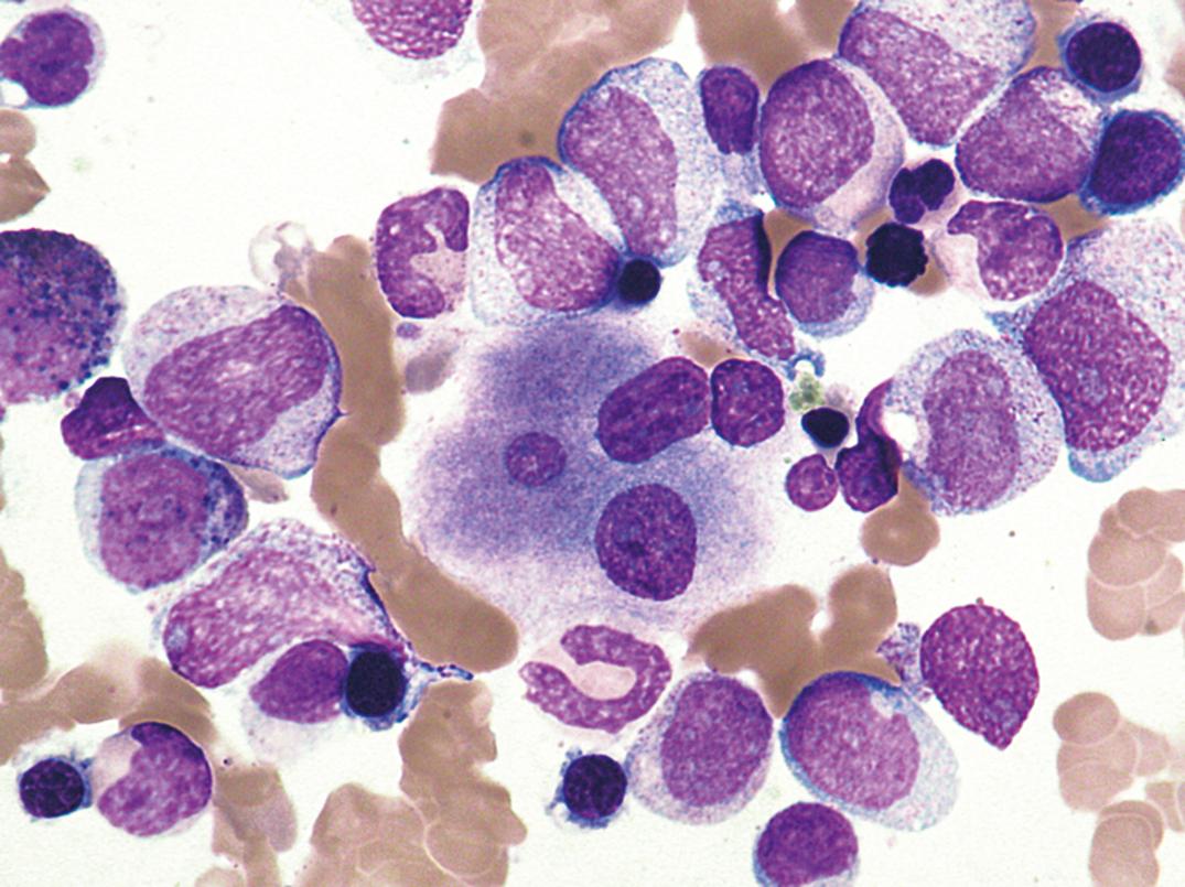 Figure 34.22, A dysplastic megakaryocyte showing unconnected nuclear lobes. Mononuclear forms are also frequent in myelodysplasia (×500).
