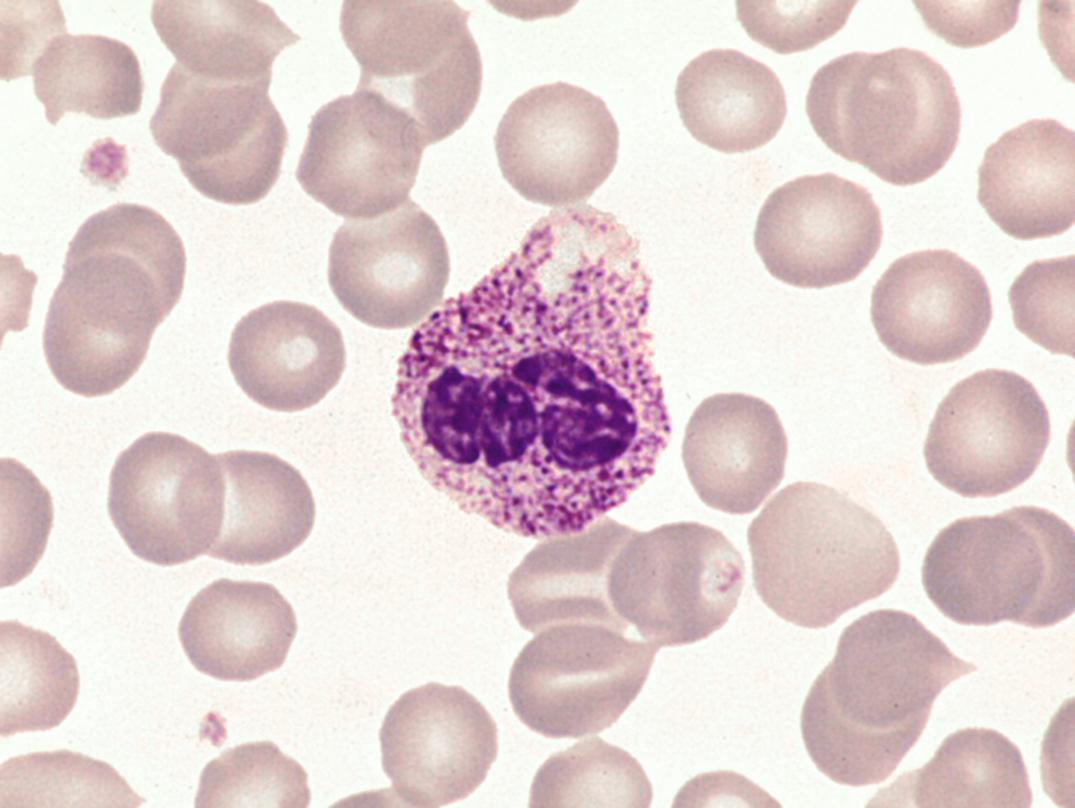 Figure 34.4, The Alder-Reilly anomaly may be found in healthy individuals or in those with mucopolysaccharidoses, in which granules are metachromatic (×1000).