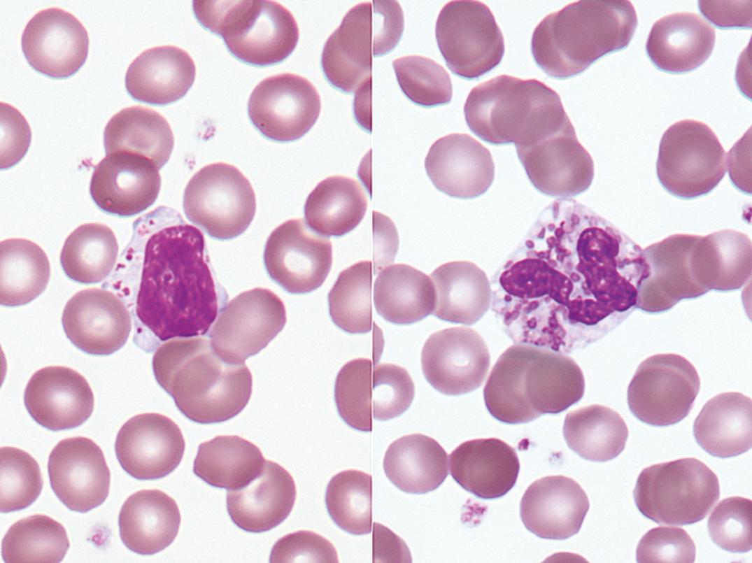 Figure 34.5, Genetic mucopolysaccharidoses often show abnormal lymphocyte granules with surrounding halos. In these cells from the same blood film, neutrophils showed similar changes (×1000).