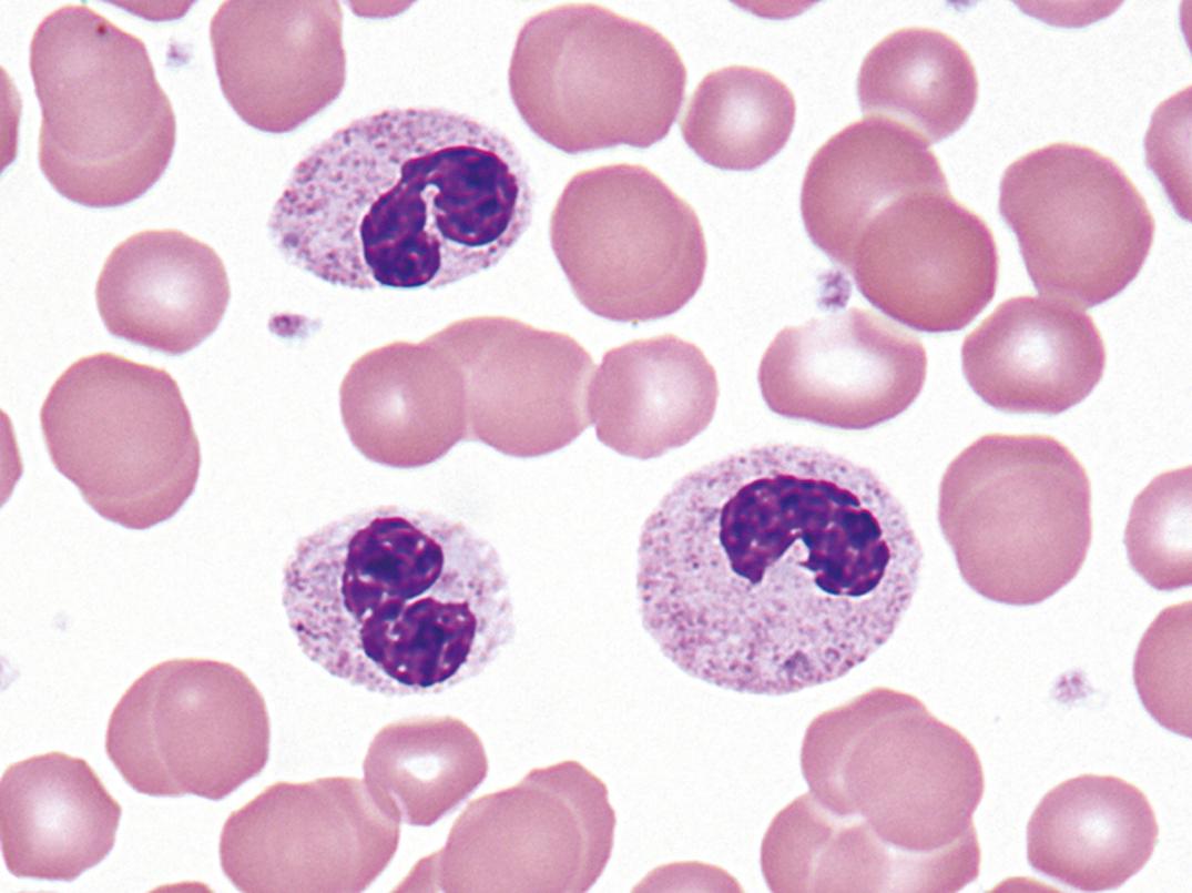 Figure 34.6, Inherited Pelger-Huët anomaly (×1000).