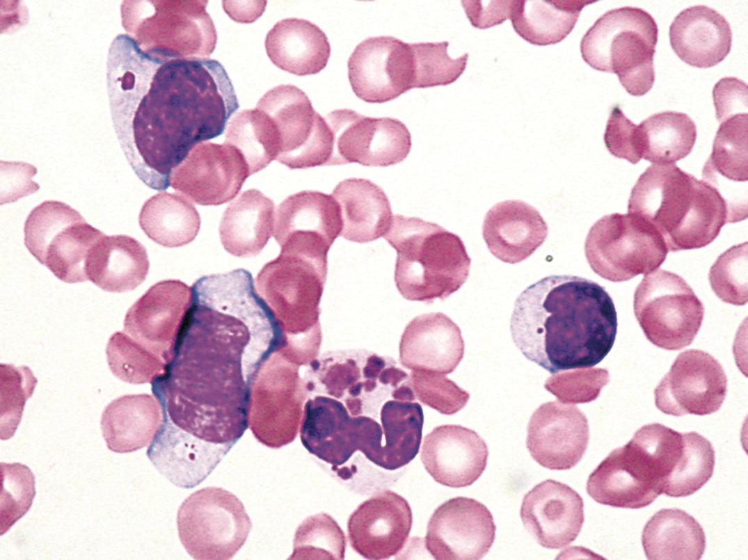 Figure 34.7, Chédiak-Higashi neutrophils and lymphocytes with large granules (×1000).