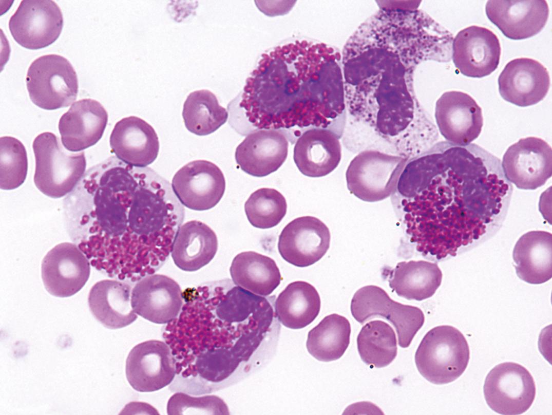 Figure 34.8, Marked eosinophilia of unknown cause, suggesting hypereosinophilic syndrome, peripheral blood (×1000).