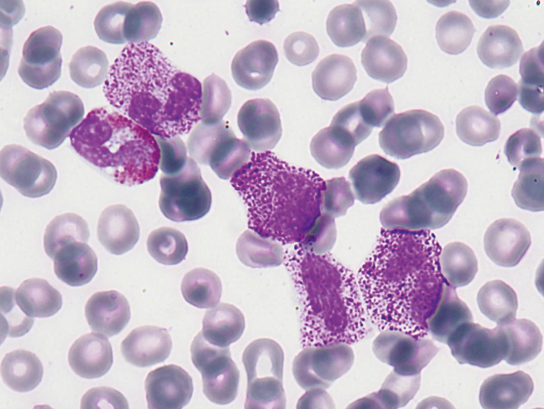 Figure 34.9, Marked basophilia and an eosinophil in a patient with Philadelphia chromosome positivity (×1000).