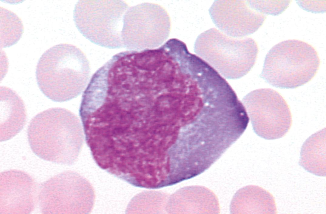 Figure 34.10, Infectious mononucleosis, showing a large activated lymphoid cell in the blood (×1000).