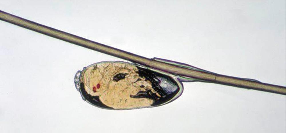 FIG. 292.4, The unhatched nit or egg of the head louse, Pediculus humanus var. capitis, attached to a hair shaft.