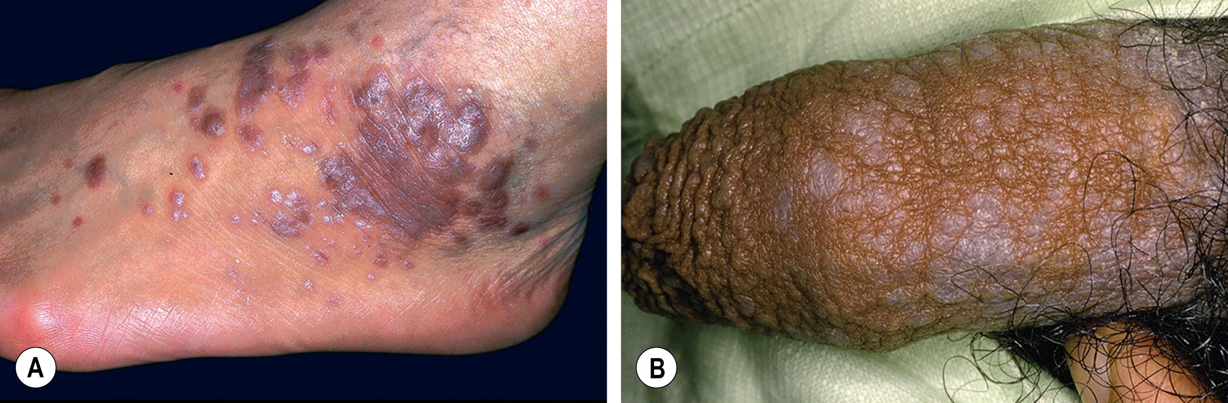 Fig. 9.1, Lichen planus.