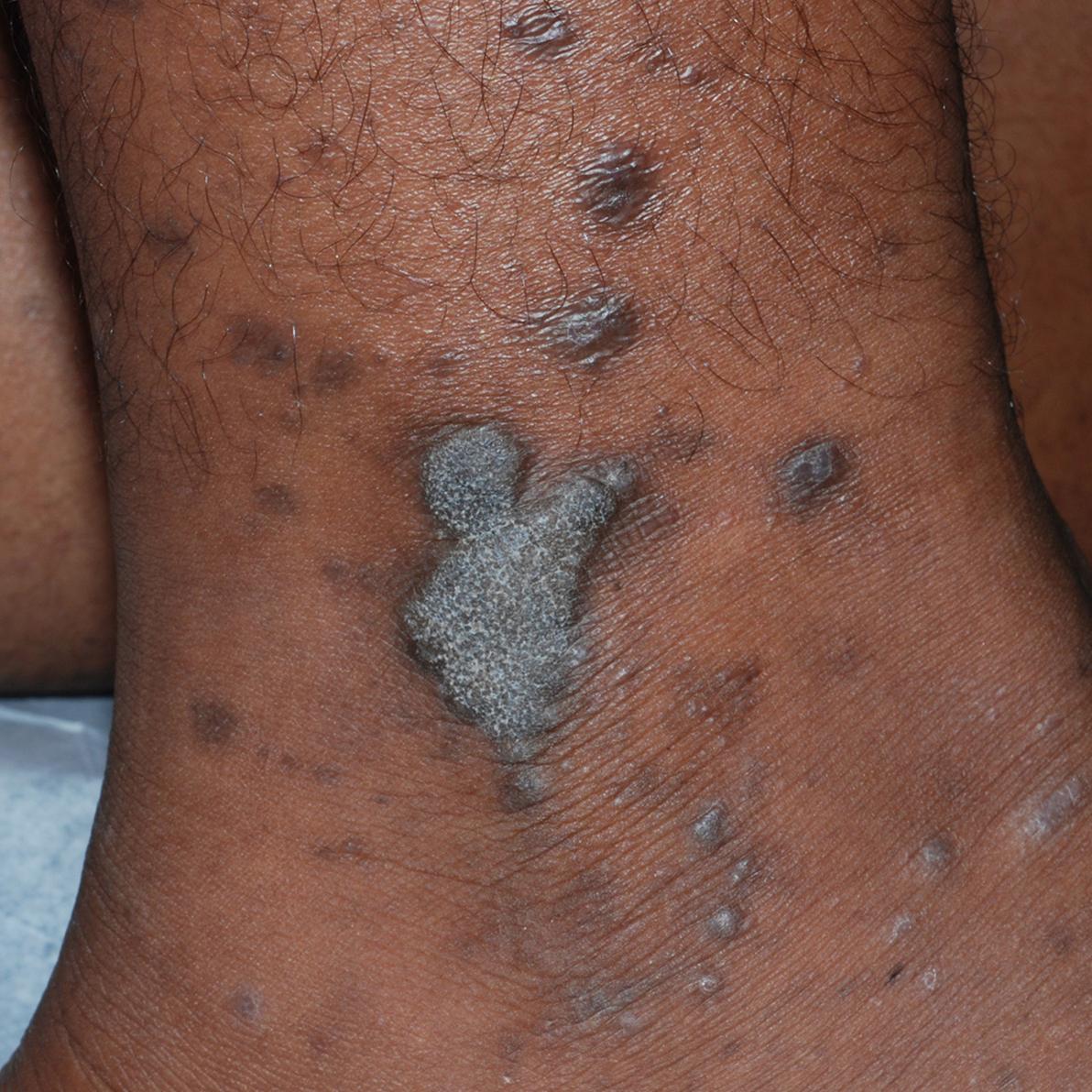 Fig. 9.3, Wickham striae in lichen planus.