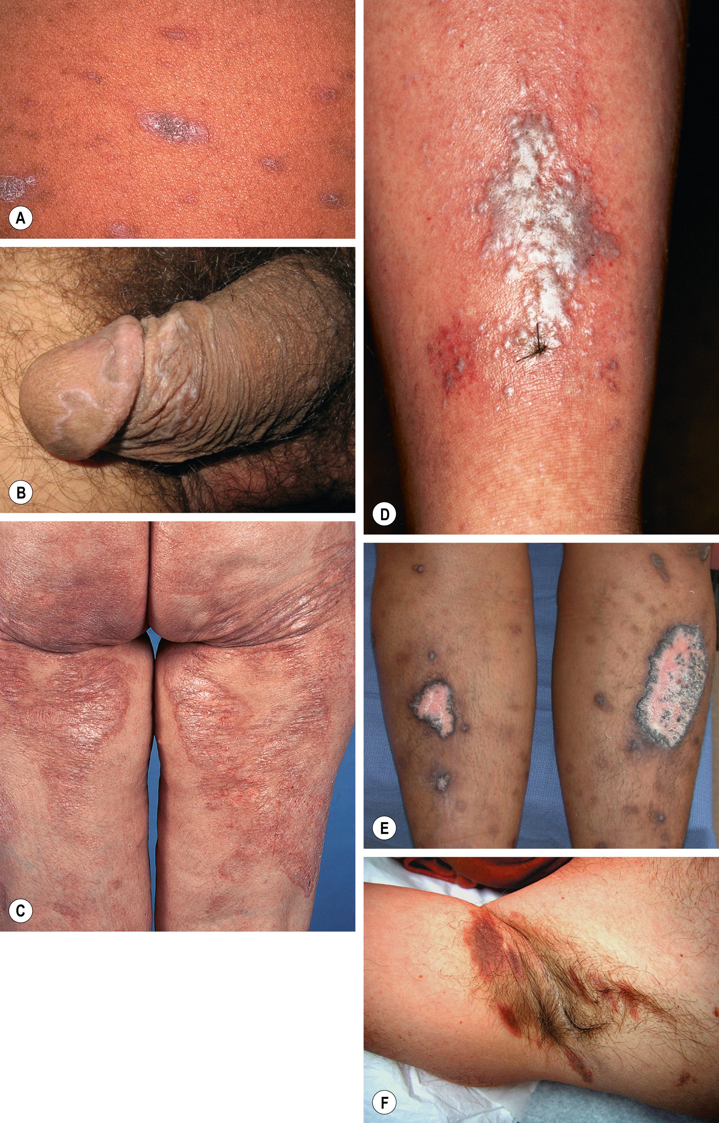 Fig. 9.5, Variants of lichen planus.