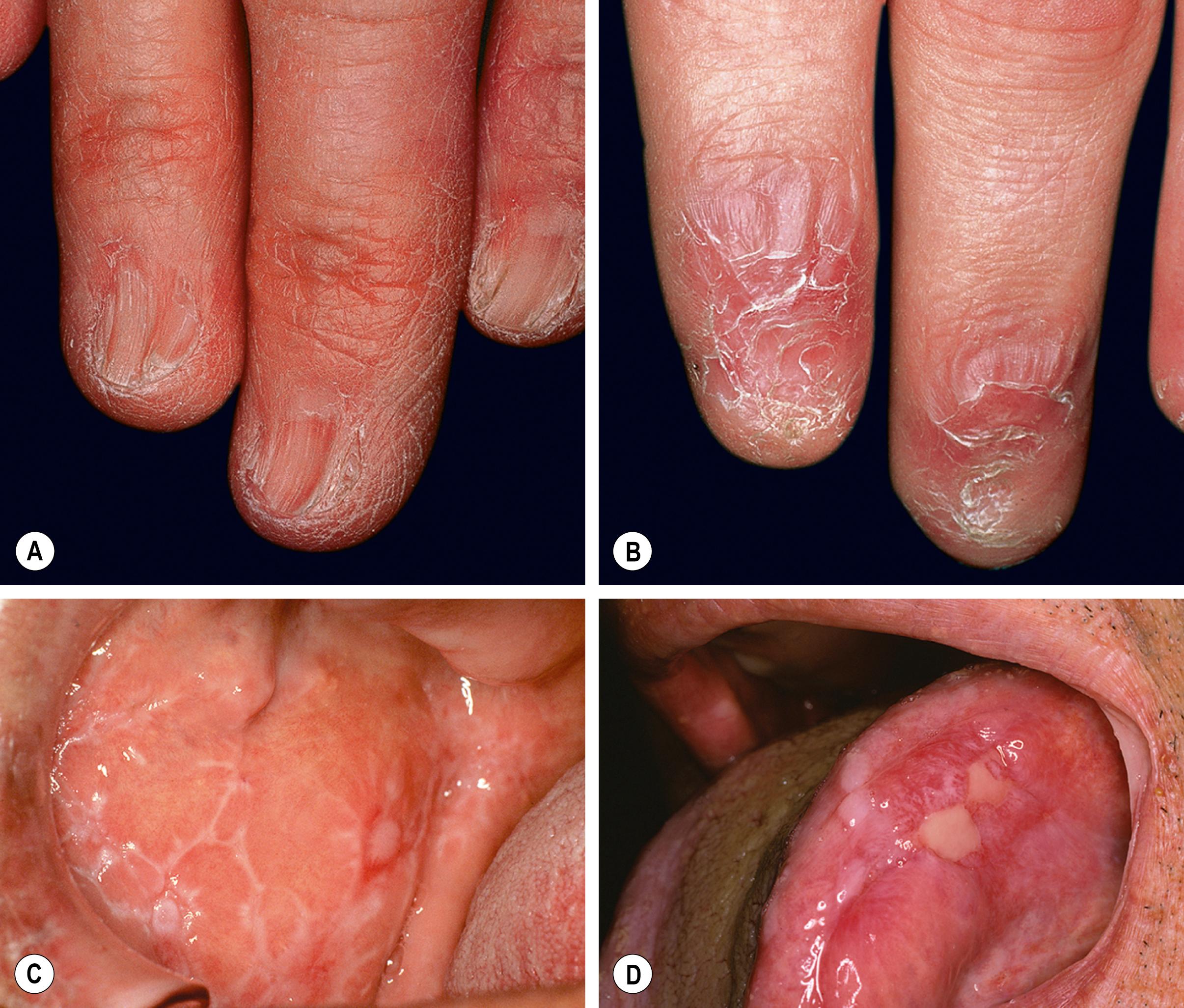 Fig. 9.6, Lichen planus of the nails and oral mucosa.