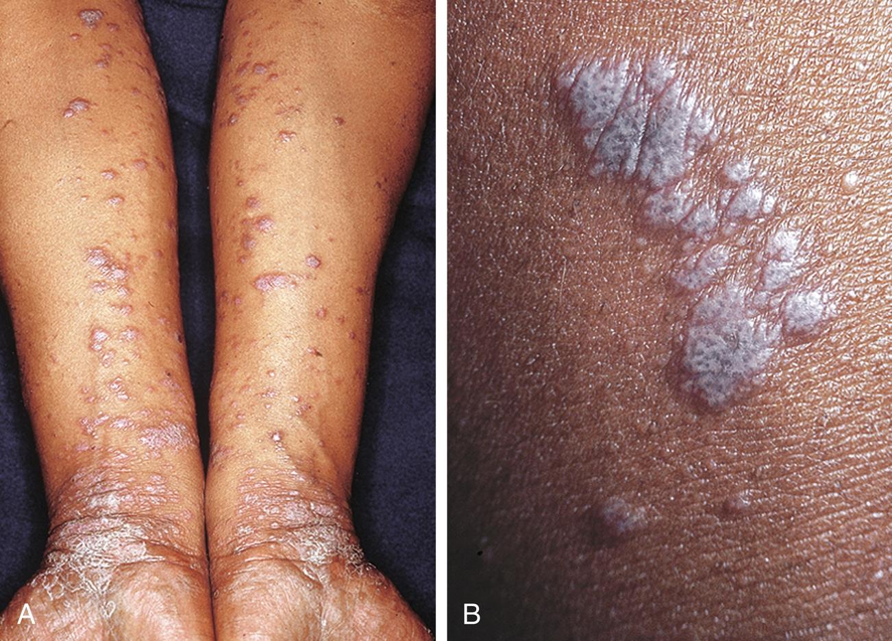 Fig. 12.1, Lichen planus. A, Typical violaceous, flat-topped, polygonal papules. The location on the volar wrist is characteristic. B, Note the Wickham’s striae.