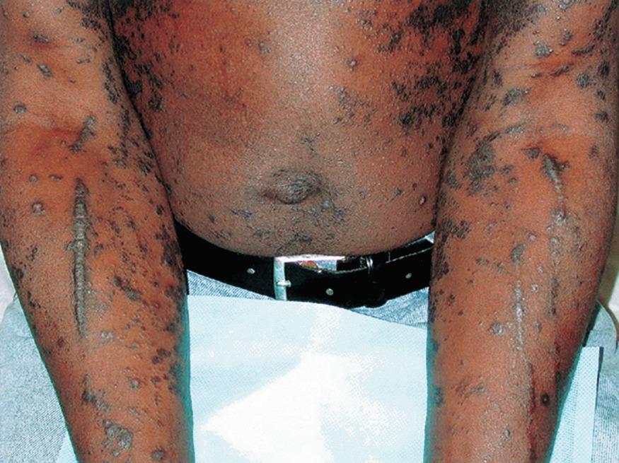 Fig. 12.3, Lichen planus with Koebner phenomenon. Note the linear distribution of secondary lesions that develop in sites of excoriation.