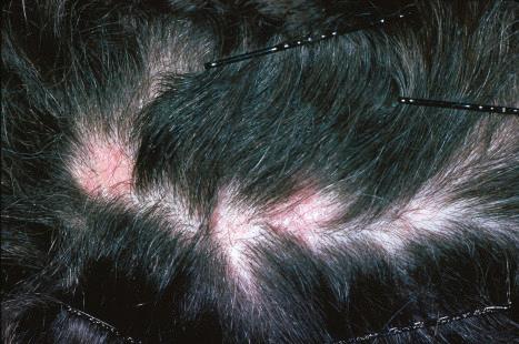 Fig. 7.12, Lichen planopilaris: marked inflammatory changes with scarring and secondary hair loss. These changes are difficult to distinguish from those of pseudopélade and chronic discoid lupus erythematosus.