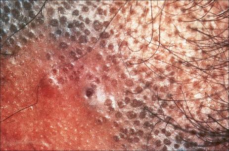 Fig. 7.13, Lichen planopilaris: follicular lichenoid papules are clearly seen in this patient.