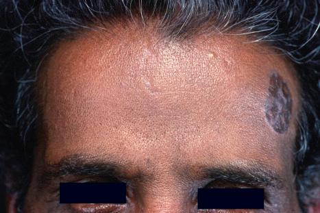 Fig. 7.16, Lichen planus pigmentosus: the face is a commonly affected site.