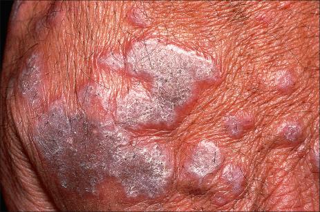 Fig. 7.17, Hypertrophic lichen planus: raised, warty, violaceous plaques on the shin of an elderly man. These lesions had been present for 30 years.