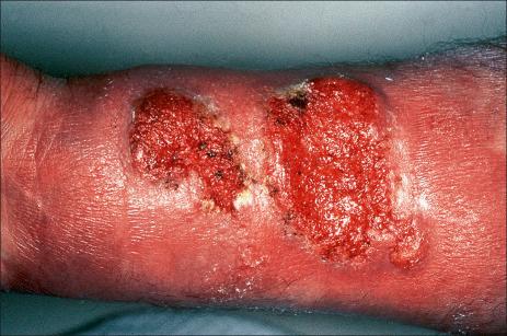 Fig. 7.18, Ulcerative lichen planus: there is marked atrophy of the skin around this crusted ulcer.