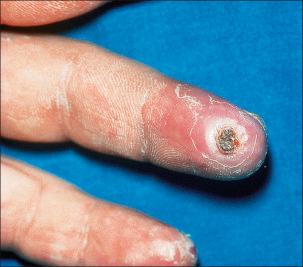 Fig. 7.19, Ulcerative lichen planus: the digits are often affected. This variant is associated with a slightly increased risk of squamous cell carcinoma.