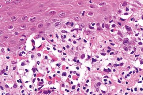 Fig. 7.20, Lichen planus: this view shows characteristic eosinophilic cytoid bodies associated with basal cell liquefactive degeneration and a lymphohistiocytic infiltrate.