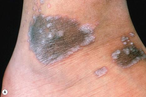 Fig. 7.2, Lichen planus: ( A ) note the characteristic Wickham striae at the edge of these pigmented lesions; ( B ) Wickham striae are evident on these lesions, which have arisen on the back, an uncommonly affected site. ( A ) From the collection of the late N.P. Smith, MD, the Institute of Dermatology, London, UK. ( B ) Courtesy of J. Dayrit, MD, Manila, The Philippines.