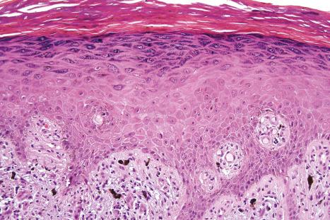 Fig. 7.22, Lichen planus: note the hyperkeratosis, hypergranulosis, and irregular acanthosis.