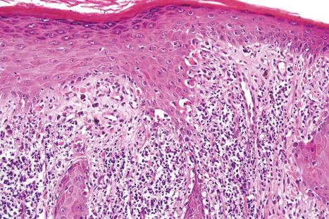 Fig. 7.24, Lichen planus: the acanthosis is irregular and often has a sawtooth appearance.