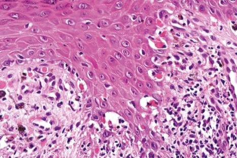 Fig. 7.25, Lichen planus: close-up view of Fig. 7.24 showing basal cell liquefactive degeneration and cytoid bodies.