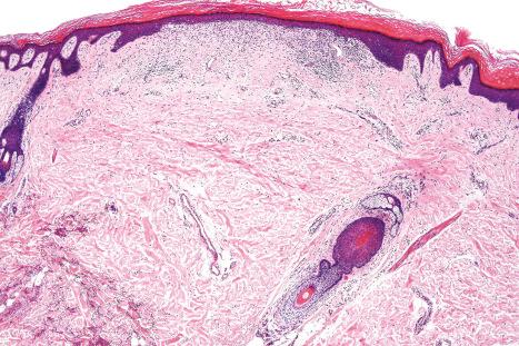 Fig. 7.27, Atrophic (resolving) lichen planus: there is hyperkeratosis, epidermal flattening, and a slight residual lymphohistiocytic infiltrate.