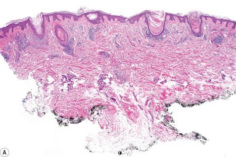 Fig. 7.30, Lichen planopilaris: ( A , B ) there is a strikingly folliculocentric bandlike infiltrate associated with keratin plugging. The interfollicular epidermis is unaffected.