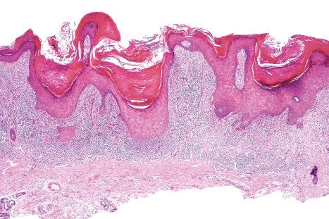 Fig. 7.31, Hypertrophic lichen planus: note the hyperkeratosis, focal wedge-shaped hypergranulosis, very marked irregular acanthosis, and superficial dense bandlike infiltrate.