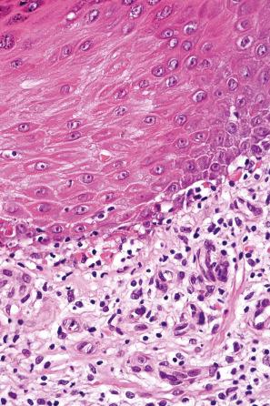 Fig. 7.33, Hypertrophic lichen planus: there is basal cell liquefactive degeneration with cytoid bodies.