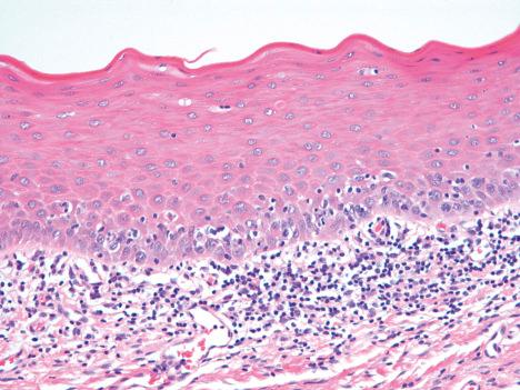 Fig. 7.34, Oral lichen planus: there is parakeratosis, a subtle granular layer, and no sawtoothing of the epithelial–subpithelial junction in contrast to cutaneous lichen planus.