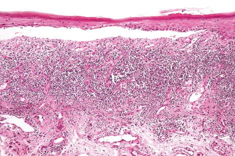 Fig. 7.35, Bullous lichen planus: oral lesion showing separation of the squamous epithelium from the lamina propria. Note the bandlike infiltrate.