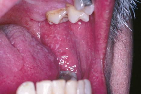 Fig. 7.4, Lichen planus: this lacelike pattern is characteristic.