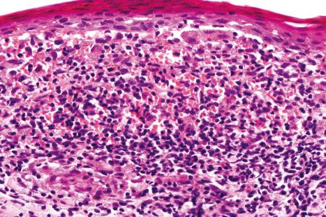 Fig. 7.42, Lichen nitidus: the infiltrate consists of lymphocytes, histiocytes, and epithelioid cells. Ill-defined noncaseating granulomata are not uncommon.