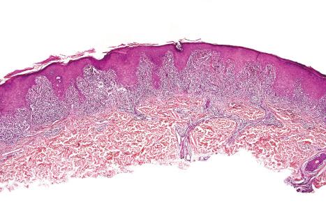 Fig. 7.45, Lichenoid keratosis: scanning view showing hyperkeratosis, hypergranulosis, irregular acanthosis, and a bandlike chronic inflammatory infiltrate.