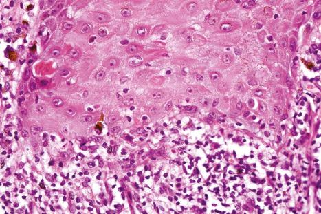 Fig. 7.46, Lichenoid keratosis: in this field there is basal cell liquefactive degeneration. Cytoid bodies are present.