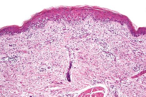 Fig. 7.48, Lichenoid keratosis: there is interface change with cytoid bodies.