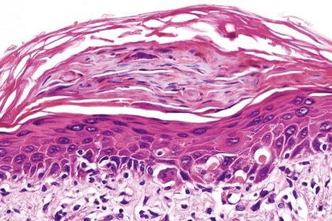 Fig. 7.49, Lichenoid keratosis: basal cell liquefactive degeneration is evident in addition to cytoid bodies. Note the parakeratosis.