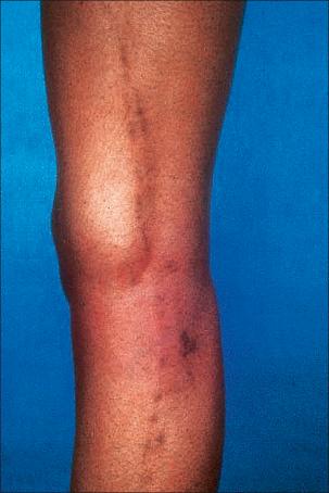 Fig. 7.50, Lichen striatus: a linear band of scaly hyperpigmented papules is present on the inner aspect of the leg, a commonly affected site.