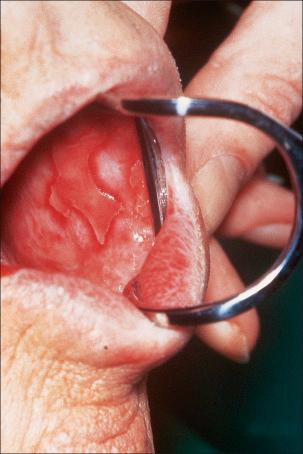 Fig. 7.5, Lichen planus: there is extensive ulceration of the buccal mucosa.