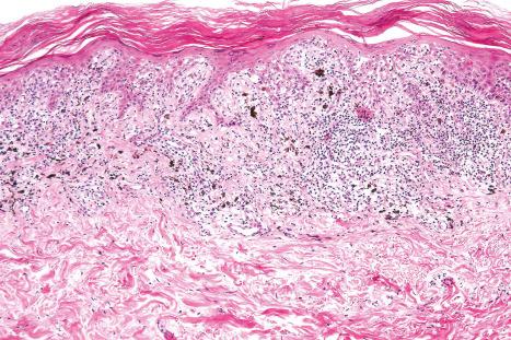 Fig. 7.52, Lichen striatus: scanning view showing hyperkeratosis, focal parakeratosis, and irregular acanthosis. A heavy inflammatory cell infiltrate is present in the upper dermis. There is conspicuous pigmentary incontinence.