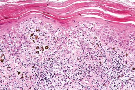 Fig. 7.53, Lichen striatus: in this field, there is parakeratosis, hyperkeratosis, spongiosis, and interface change. Note the pigment incontinence and intense chronic inflammatory cell infiltrate.