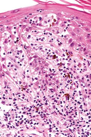 Fig. 7.54, Lichen striatus: there is spongiosis and marked lymphocytic exocytosis.