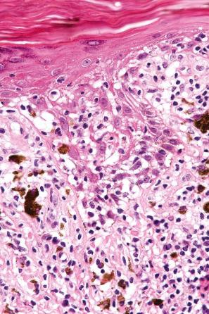 Fig. 7.55, Lichen striatus: there is spongiosis, marked lymphocytic exocytosis, basal cell liquefactive degeneration, and pigmentary incontinence.