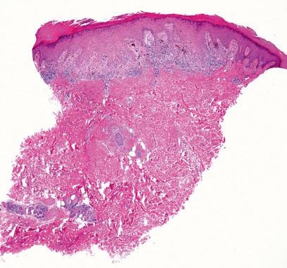 Fig. 7.56, Lichen striatus: the scanning image demonstrates a lichenoid interface dermatitis and a deeper perieccrine infiltrate.