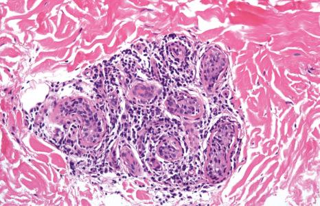 Fig. 7.57, Lichen striatus: note the perieccrine lymphocytic infiltrate.