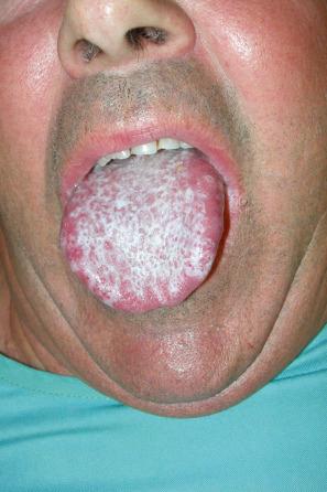 Fig. 7.6, Lichen planus: the tongue is commonly affected.