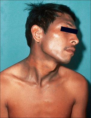 Fig. 7.62, Erythema dyschromicum perstans: in this patient, there is extensive involvement of the face, neck, and trunk.