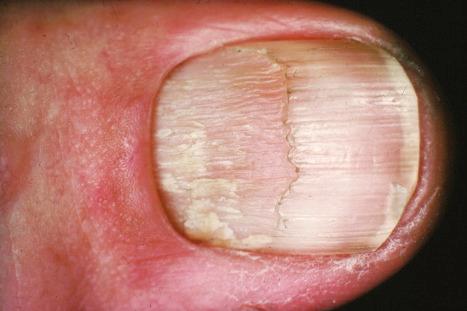 Fig. 7.9, Lichen planus: there is longitudinal ridging and striation affecting the thumbnail, with inflammatory changes in the nail folds.